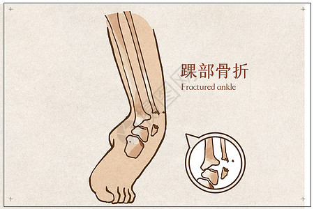 踝部骨折病例医疗插画图片