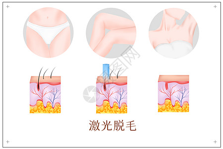 脱毛器激光脱毛医美插画插画