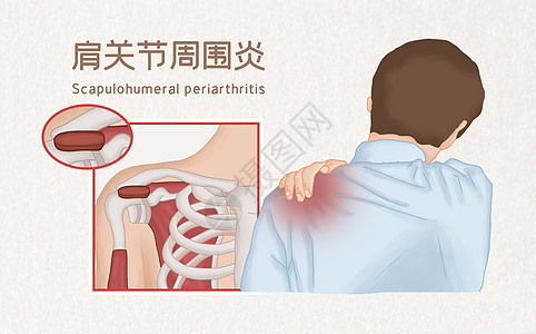 肩关节周围炎医疗插画图片