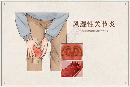 风湿性关节炎医疗插画图片