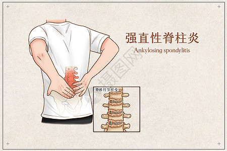 强直性脊柱炎医疗插画人体高清图片素材