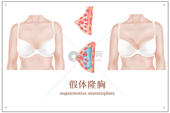 假体隆胸手术插画图片