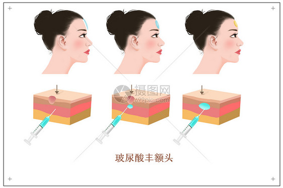 玻尿酸丰额头医美医学插画图片