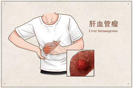 肝血管瘤医疗插画图片