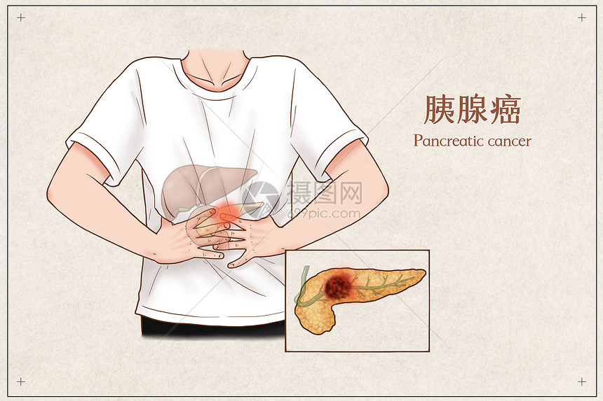 胰腺癌医疗插画图片