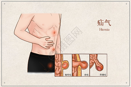 疝气医疗插画图片