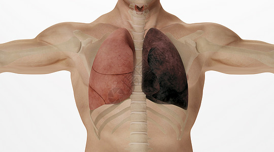 人体肺部病变场景背景图片
