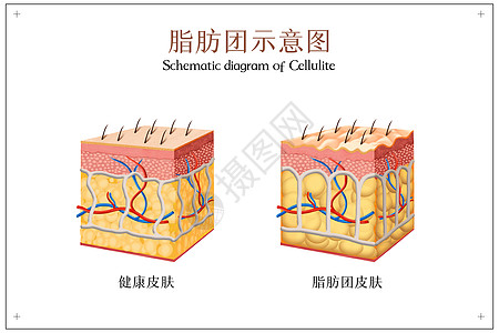 脂肪团示意图背景图片