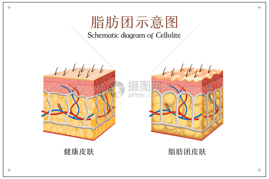 脂肪团示意图图片