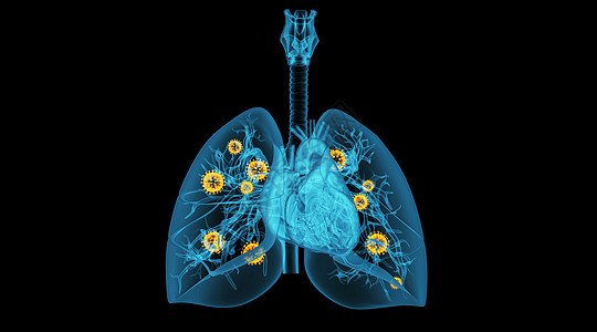 肺部病变场景图片
