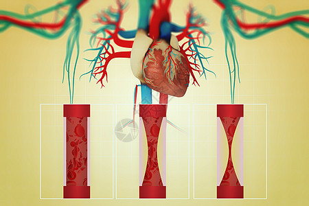 心脏疾病血管堵塞高清图片