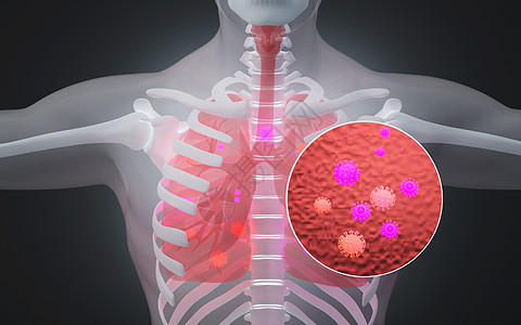 肺病人体肺部病毒病变设计图片