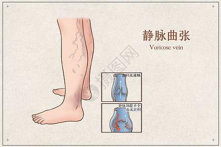 静脉曲张医疗插画背景图片