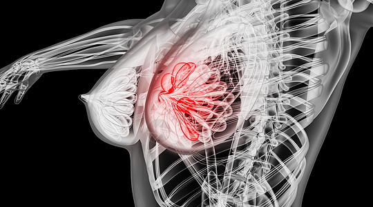 人体乳腺病变场景图片