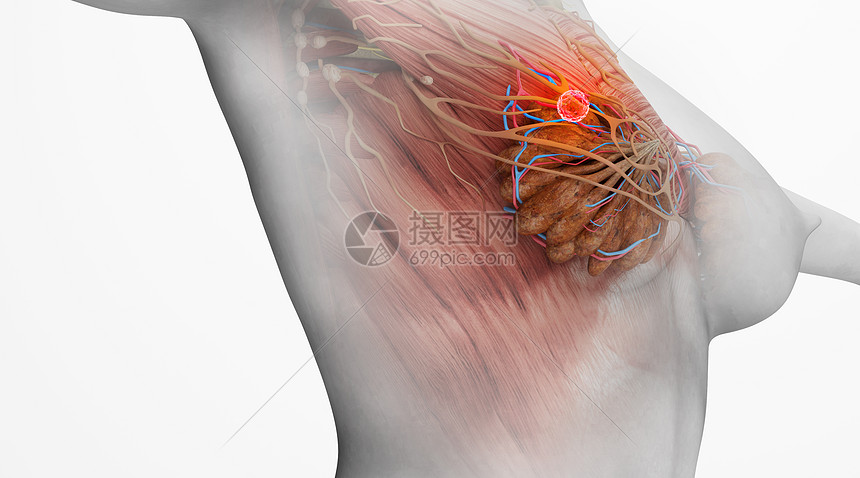 乳腺癌病变场景图片
