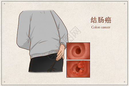 结肠癌医疗插画图片