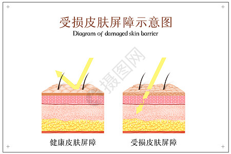 皮克受损皮肤屏障示意图插画