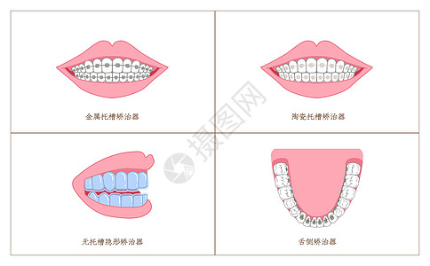 牙齿矫正材料分类科普插画高清图片