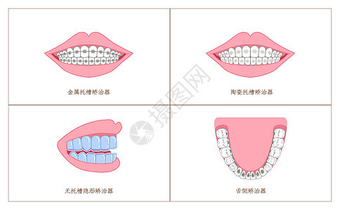 牙齿矫正材料分类科普插画图片