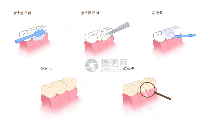 牙齿涂氟步骤科普插画图片