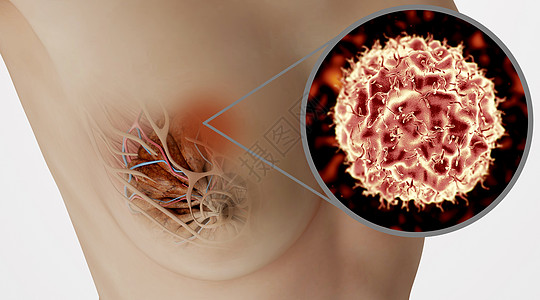 生殖系统乳腺癌病变场景设计图片