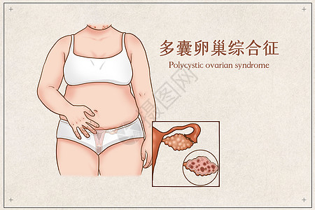多囊卵巢综合征医疗插画高清图片