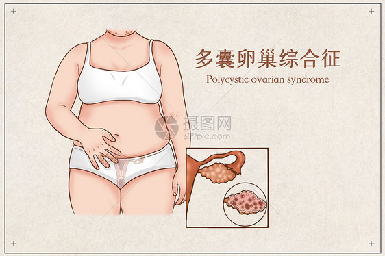 多囊卵巢综合征医疗插画图片