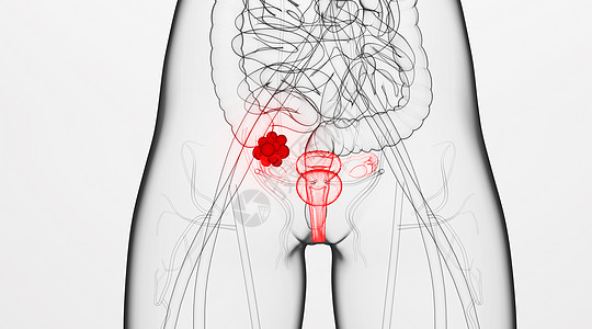 人体卵巢病变场景图片