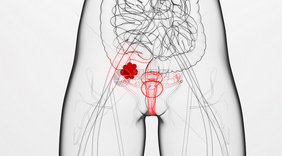人体卵巢病变场景图片