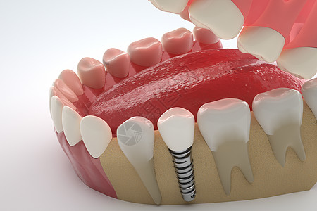 医美种植牙医疗建模高清图片