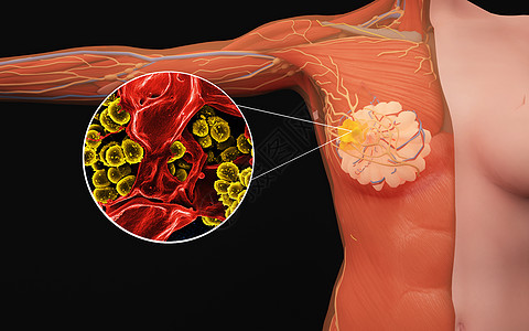 人体女性乳腺病变图片