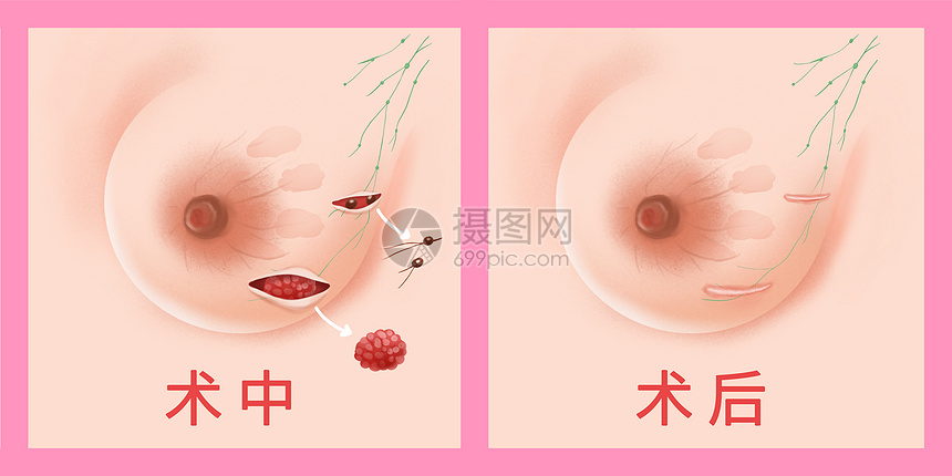乳腺癌保乳手术医疗插画图片