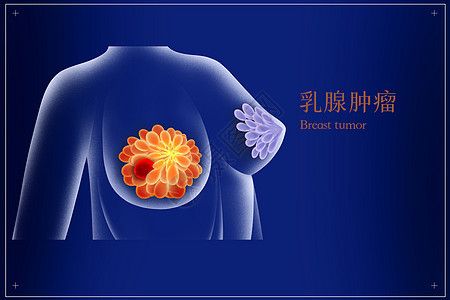 乳腺癌乳腺肿瘤医疗插画背景图片