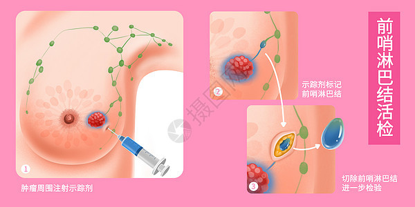 乳腺癌前哨淋巴结活检医疗插画图片