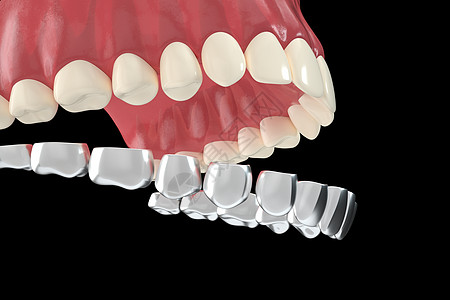 牙套C4D牙齿矫正场景设计图片