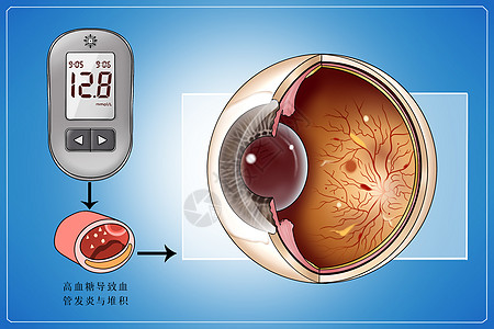 糖尿病并发症视网膜病变医疗插画背景图片