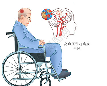 高血压病变中风医疗插画高清图片