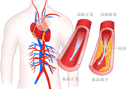 高血压血管病变医疗插画高清图片