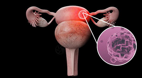 生殖系统子宫病变场景设计图片