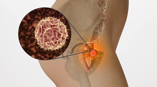 生殖系统子宫病变场景设计图片