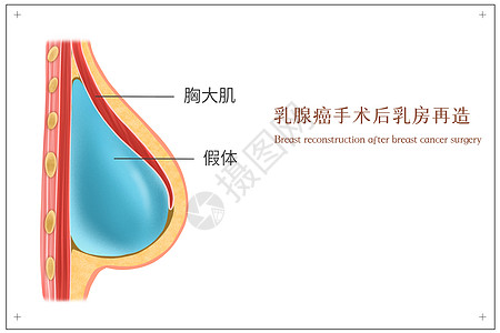 乳腺癌手术后乳房再造医疗插画图片