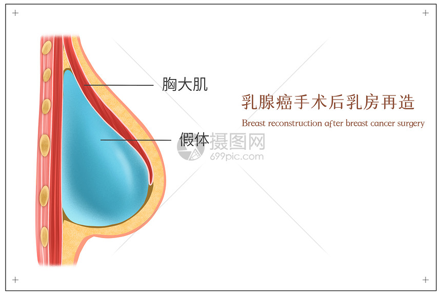 乳腺癌手术后乳房再造医疗插画图片