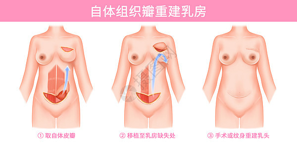 乳腺癌自体组织瓣重建乳房医疗插画图片