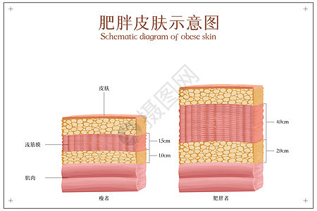 皮肤肥胖示意图图片