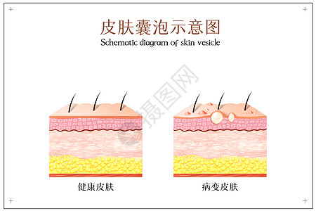 泡小米椒皮肤病变之皮肤囊泡示意图插画