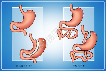 糖尿病手术治疗医疗插画图片