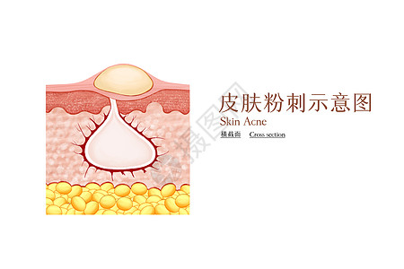 祛痘护理皮肤粉刺示意图插画