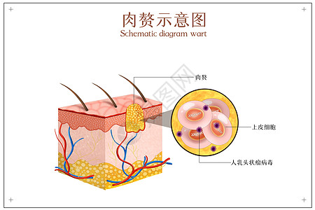 皮肤病变之肉赘示意图高清图片