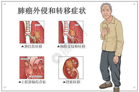 肺癌外侵和转移症状医疗插画图片