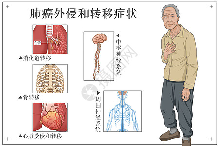 肺癌外侵和转移症状医疗插画背景图片